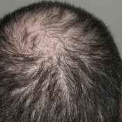 Hair Loss Instant Mobile Video Site