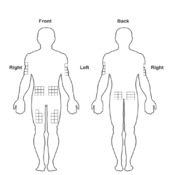 Diabetes Injection Site Rotation