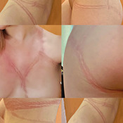 Shibari Marks